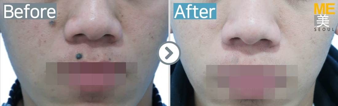 Mole removal - ME CLINIC SEOUL