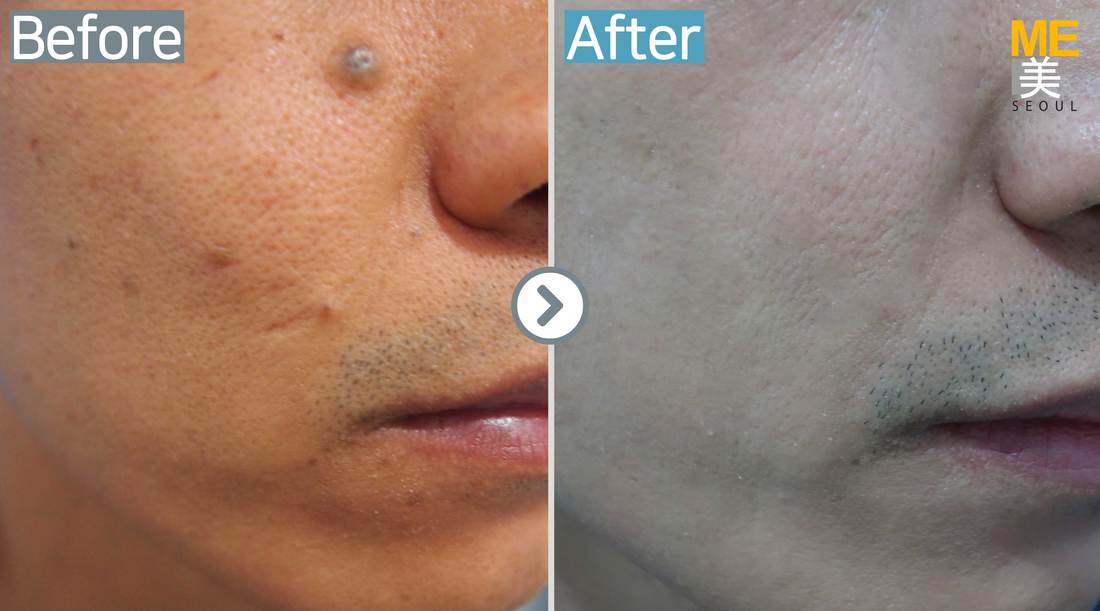 Mole removal - ME CLINIC SEOUL