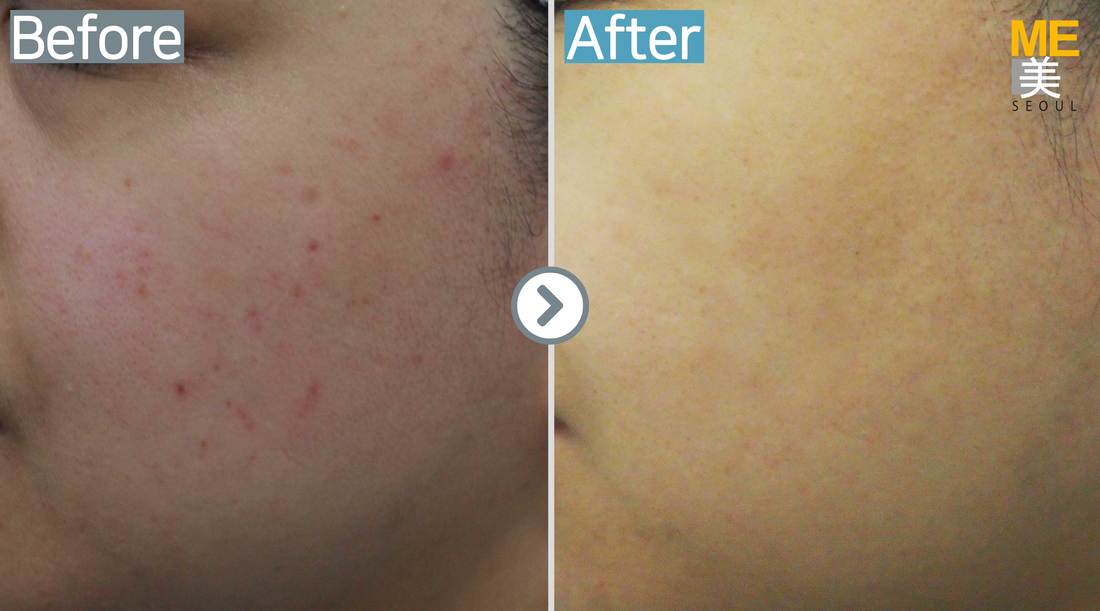 Acne scar ME CLINIC SEOUL