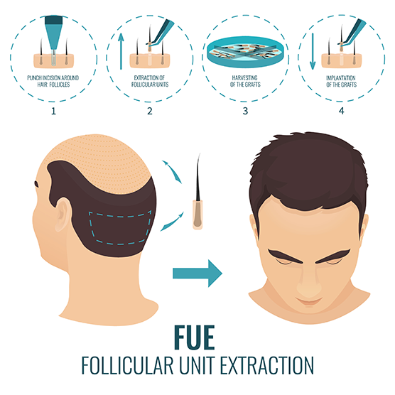 Hair transplantation