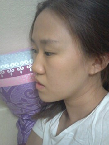 Hiko nose lift | Korea | Before