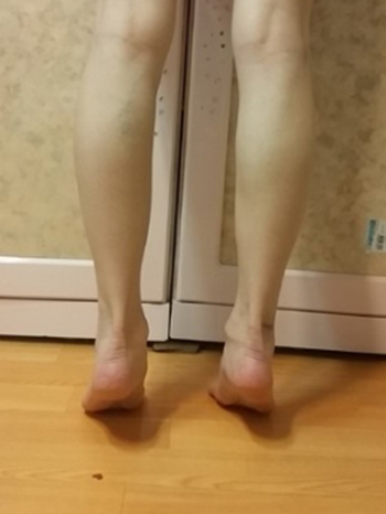 Calf reduction | Korea | After