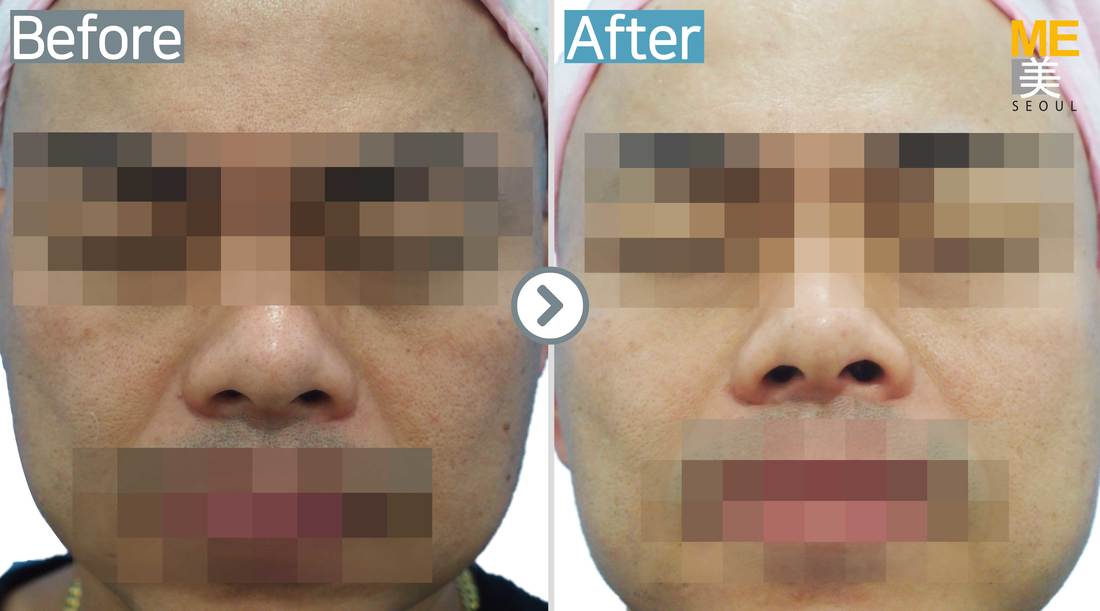 youtube glutathione injection Why Is Glutathione Added as a Push? main image 0