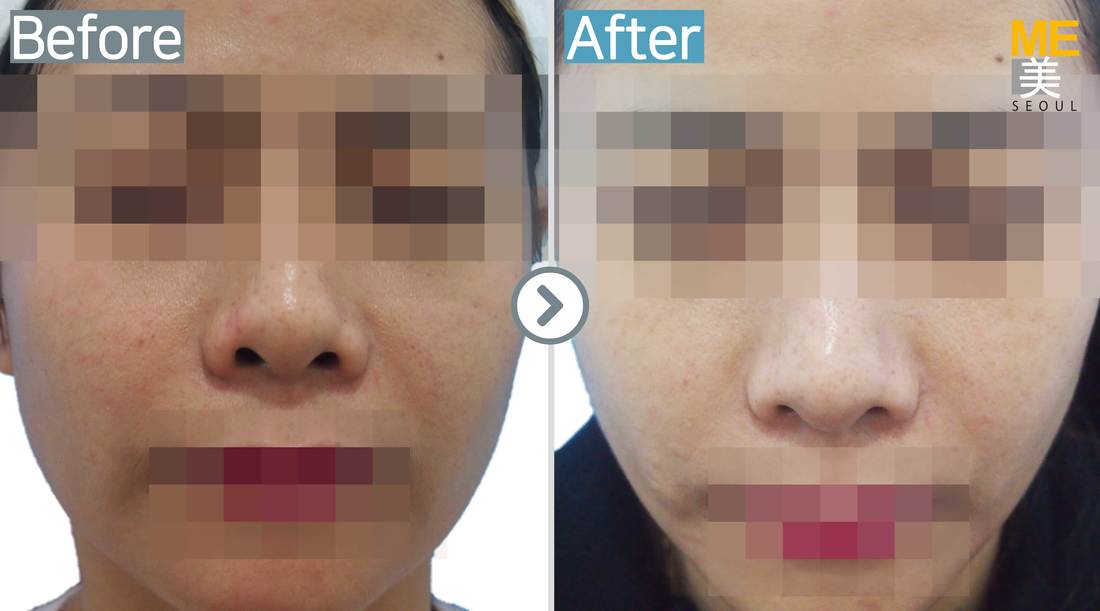 Glutathione injection ME CLINIC SEOUL Glutathione injection ME CLINIC SEOUL