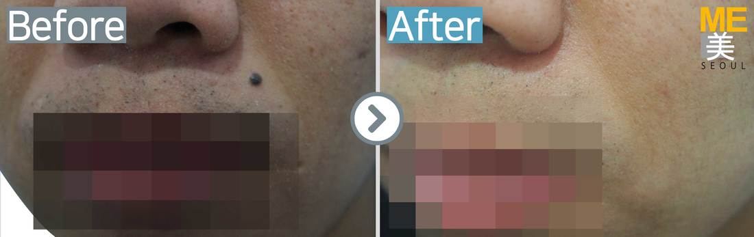 Mole removal - ME CLINIC SEOUL
