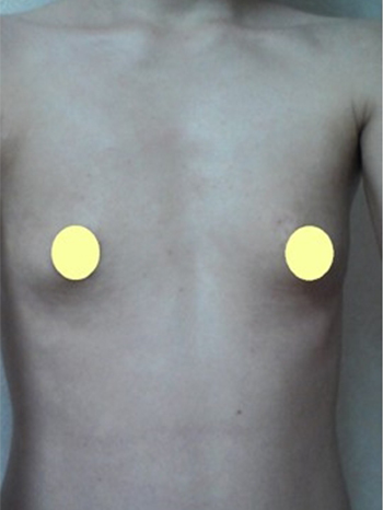 Breast implant / Korea / Before