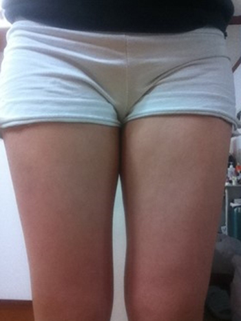 Thigh liposuction | Korea | Before