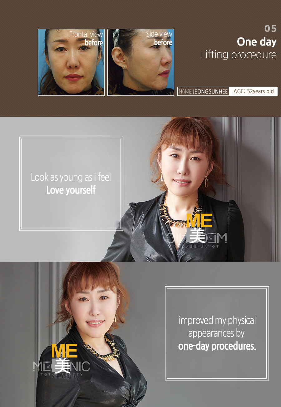 03 ONE DAY Lifting procedure