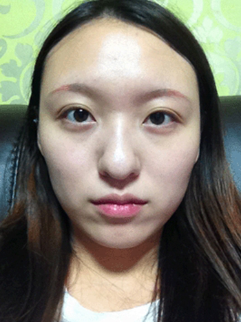 Nose dermal filler | Korea | Before