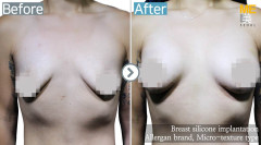 Singapore / Breast implant (Sebbin brand Tear drop type)