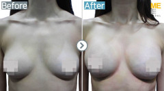 Singapore / Breast implant (Sebbin brand round type)