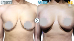 Malaysia / Breast implant (Allergan brand Round type breast implant)
