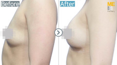 Singapore / Breast implant (Sebbin brand Tear drop type,Breast lifting & gynecomastia)