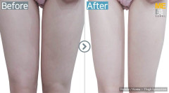 Korea / Liposuction (Thigh Liposuction)