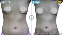 Singapore/ Liposuction (Mini lower Abdomen liposuction)