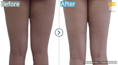 Korea / Liposuction (Thigh Liposuction)