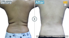 Singapore / Liposuction (Brassiere line liposuction)