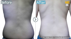U.K / Liposuction (Love handle liposuction)