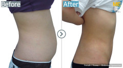 Korea / Liposuction (Abdomen Liposuction)