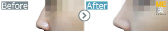 Korea / Rhinoplasty (whole nose)