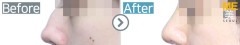 Singapore / Rhinoplasty (whole nose)