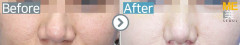 USA / Rhinoplasty (Nose alar reduction)