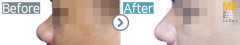 Singapore / Rhinoplasty (whole nose)
