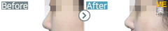 Singapore / Rhinoplasty (Nose tip &Nose bridge)