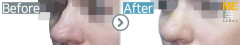 Russia / Rhinoplasty (Nose tip & Nose lifting)