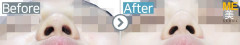 Singapore / Rhinoplasty (Nose alar reduction)