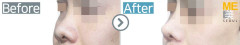 Vietnam / Rhinoplasty (Whole nose)
