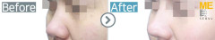 Singapore / Rhinoplasty (Whole nose)