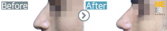 Singapore / Rhinoplasty (Nose bridge& nose tip)