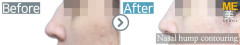 Russia / Rhinoplasty (Hump nose correction& nose lifting)
