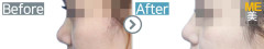 Singapore/Rhinoplasty (Nose bridge&nose tip)