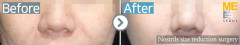 Singapore/Rhinoplasty (Nostrils size reduction surgery)
