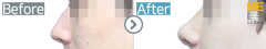 Russia / Rhinoplasty (Hump nose correction& nose lifting)