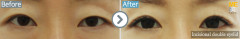 USA / Incisional double eyelid