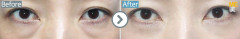 Japan / Non- incision type (Reposition surgery of fats on lower eyelids