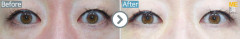 Singapore / Non- incision type (Reposition surgery of fats on lower eyelids