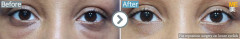 Malaysia / Fat reposition surgery on lower eyelids