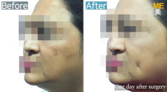Singapore/ Dimple (both side)