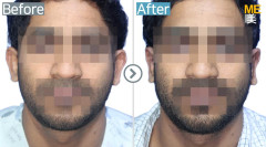 Pakistan / Otoplasty