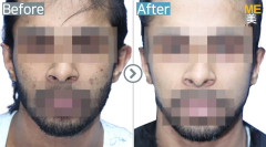 Arab Emirates / Otoplasty