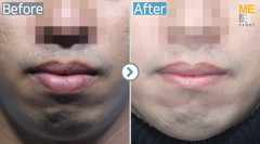 Singapore / Lip size reduction