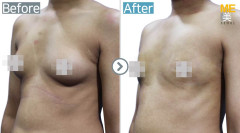 Singpaore/Gynecomastia