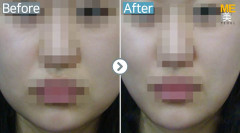 Singapore / Ultherapy
