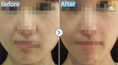 Singapore / Ultherapy