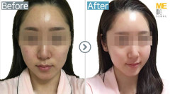 Korea / Rejuran healer