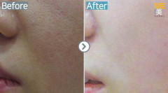 Singapore / Acne scar (Legato)
